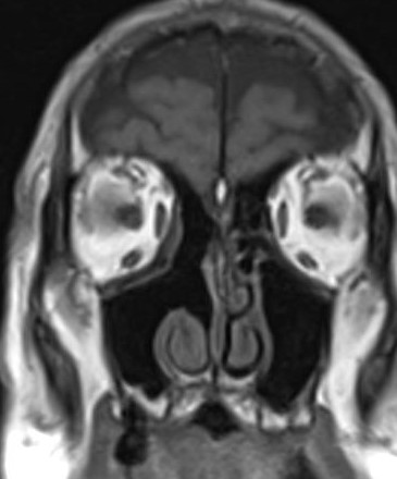 Figure 5: Evolution of the Surgery for Tumors Involving the Anterior Skull Base.