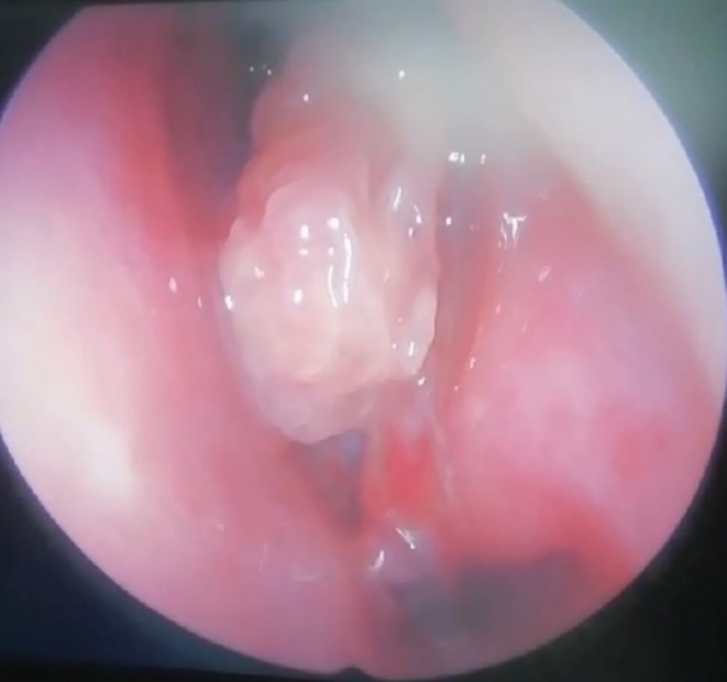 Figure 1: Inverted Papiloma oft Left Half of the Nose.