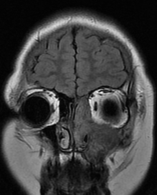 Figure 3: MRI of the Head, COR T2 FLAIR.
