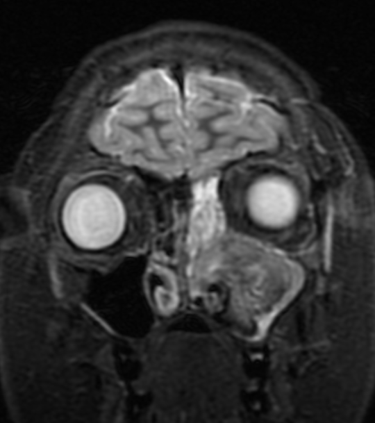 Figure 4: MRI Cor Stir FSE.