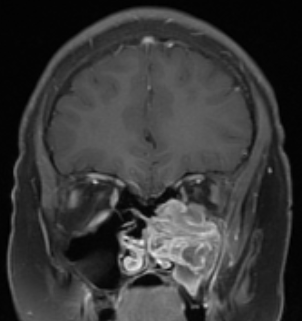 Figure 5: Contrasted MRI (Coronal and Sagital).