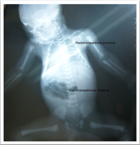 Figure 2: Radiological Docimasia, Note Air at Pulmonary and Gastric Level.