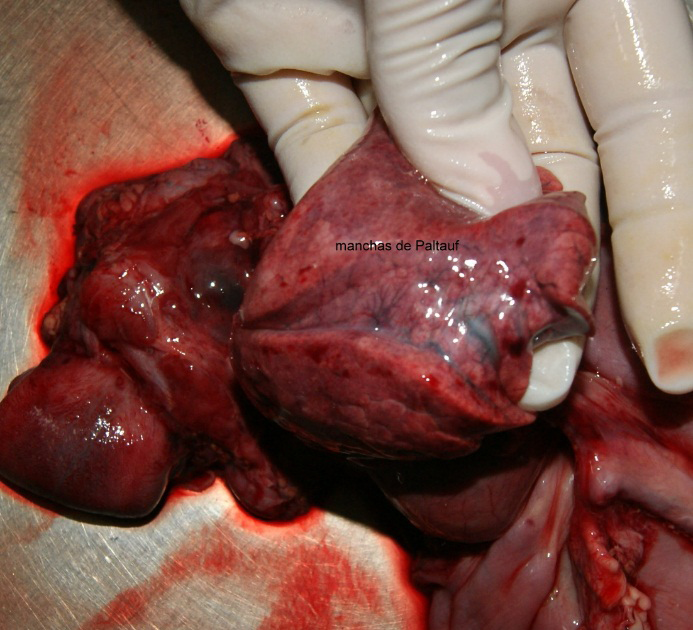 Figure 5: Paltauf’s Stains, Typical of Submersion, Consist of Microhemorrhages in Dilution, Wider and Clearer than Tardieu’s, Produced only if there has Been Breathing and Circulation Producing Blood Pressure.