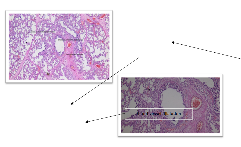 Figure 6: Note the Bronchial, Alveolar and Blood Vessel Dilatation.