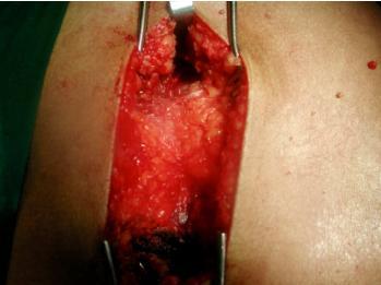 Figure 2: Photo showing the longitudinal surgical approach.