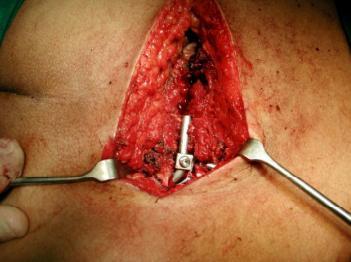 Figure 3: Photo showing application of the rod. The direction of the rod in the frontal plane was downward in all patients according to Galveston method. Two rod-screw connectors were attached to the inserted rod caudally placed in the rod connection to avoid irritation of the L5-S1 facet joint by the connector. For reduction of vertical displacement and angular deformity of the sacroiliac joint, compression force was applied between the inserted rod and each S1pedicle screw using a rod holder and compressor. After introduction of the rod –screw connectors to the pedicle screw, nuts attached to the two screws were alternatively tightened for further reduction (Figure 4). If the space of sacroiliac joint is still widened, compression force was applied between each S1 pedicle screw and the rod to close the opening. After completion of the internal fixation, divided paravertebral muscles were resutured and skin closure was performed. Three out of five patients with symphysis pubis major disruption underwent additional fixation of the symphysis pubis with using dynamic compression plate. The remaining patients were treated by the posterior procedure only.