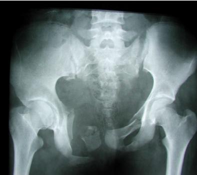 Figure 5: Preoperative x-ray of 32 years old male with left sacroiliac dislocation.