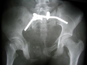 Figure 6: x-ray after perfect reduction of the dislocated left sacroiliac joint.