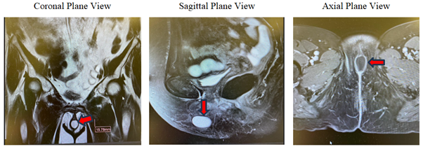 Figure 2: Magnetic Resonance Imaging of the clitoral mass (see red arrows).