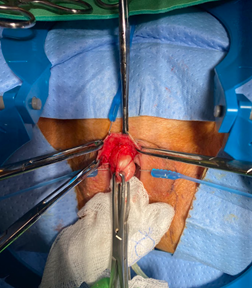 Figure 5: Intraoperative Photos of excising the clitoral mass Postoperative Follow Ups At 2 weeks postoperative visit, the patient was recovering well without any concerns. The surgical site was healing well
