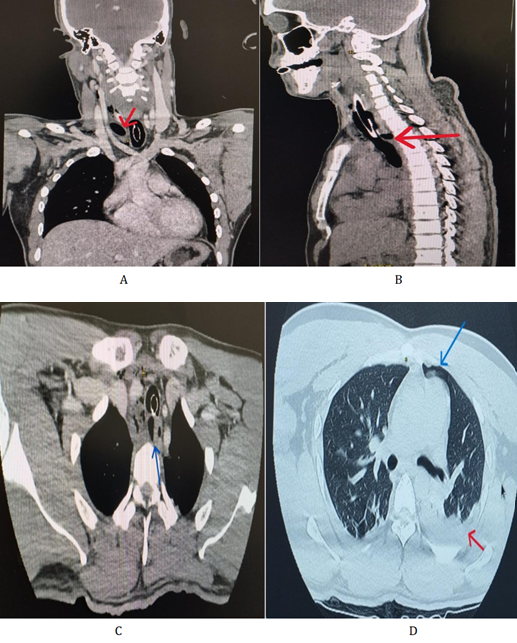 Figure 2: Cect Neck and Chest Showing A- Foreign Body (Red Arrow) Anterior To Right Common Carotid Artery. B- Fb (Red Arrow) Behind Trachea in Superior Mediastinum. C- Fb (Blue Arrow) Located In the Right Para-Oesophageal Region and Compressing Esophagus towards Left. D- Pneumomediastinum (Blue Arrow) With Feature of Hydro pneumothorax (Red Arrow) On the Left Side.