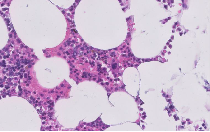 Figure 1: Mature adipocytes and hematopoietic elements characteristic of myelolipoma.