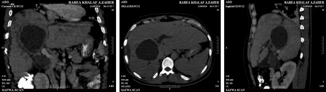 Figure 1: MDCT scan, cystic lesion communicating with hepatic duct. A) Transverse section B) Coronal section C) Sagittal section.