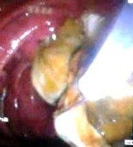 Figure 10: CBD stenting after removal of membranes.