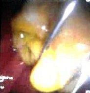 Figure 12: Fluoroscopic picture showing start of cyst calcification with obliteration of its cavity.
