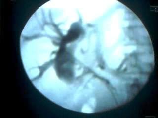 Figure 4: Aspiration of yellowish green infected fluid.