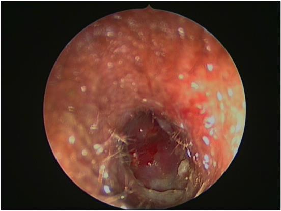 Figure 2: Endoscopic view of the right external auditory canal following removal of a button battery, showing stenosis of the external auditory canal.