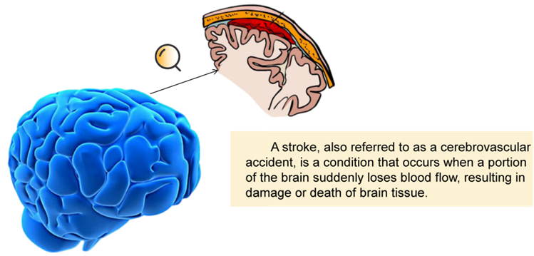 Figure 1: Historically, hemorrhagic stroke and its therapeutic interventions have grappled with many pivotal concerns [4], including hematoma expansion [5], edema, and prognostic evaluation [6].