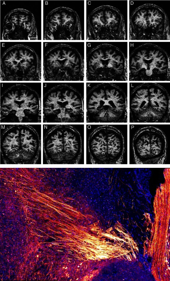 Figure 4: ** Pictures depict some biotic fractal pictures coming from the brain. The top pictures (A) shows images of the human brain obtained with Magnetic Resonance Imaging (MRI) in a rostro-caudal approach. The other pictures belongs to the Cajal´s drawings exploring the pyramidal neurons in the brain cortex. Both representations show an amazing symmetry and equilibrium between two hemispheres or adjacent neurons, reminding the fractal effect of images on a mirror. Pictures bellow (B) show another real biological images of the brain, fibbers (pic on the left) and neurons (red) with astrocytes (green) (pic on the right) (images obtained with permission from the Icahn School of Medicine at Mount Sinai). It is noticeable how the fractal nature is more elusive or difficult to capture for naked eye in biological pictures (B) _vs_ the pictures in A.