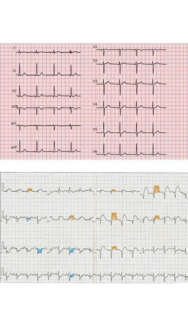 Figure 5: Measurement of the electrocardiogram (ECG) in human heart beat, for a normal state (A) and during a coronary infarction (B). It is noticeable how both cases are following a self repeated pattern of rhythmic temporal fractal. From Wikipedia Commons public domain.