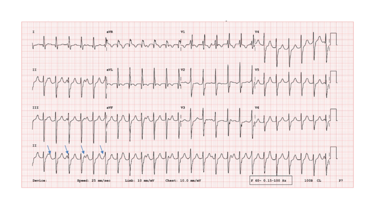 Figure 1: 12-lead electrocardiogram showing regular WCT with AV dissociation. Note that the ventricular rate is higher than atrial rate (arrows). Relatively narrower complex, RBBB and superior axis suggestive of posterior fascicular VT. Note: WCT – wide complex tachycardia, RBBB – right bundle branch block, VT – ventricular tachycardia, AV – atrioventricular.