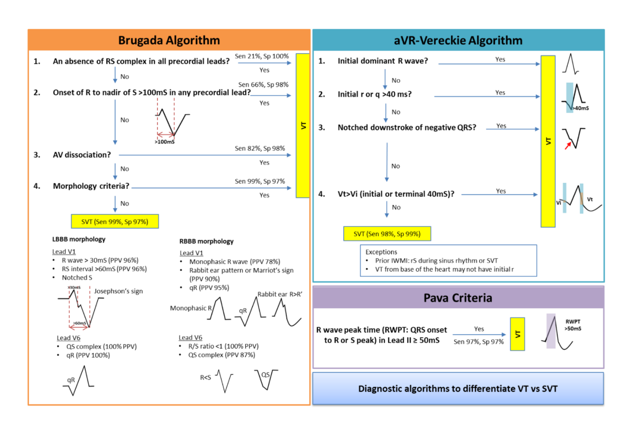 Figure 3: Diagnostic approaches and algorithms [1-5]. Note: SVT – supraventricular tachycardia, VT – ventricular tachycardia, RBBB – right bundle branch block, LBBB – left bundle branch block, AV – atrioventricular, Sen – sensitivity, Sp – specificity.
