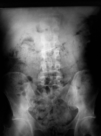 Figure 1: Frontal chest radiograph showing the metalloceramic bridge in the anatomic location of the stomach.