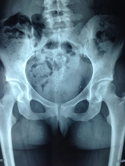 Figure 2: Abdominal radiograph showing an orthodontic wire in the middle part of the abdomen.