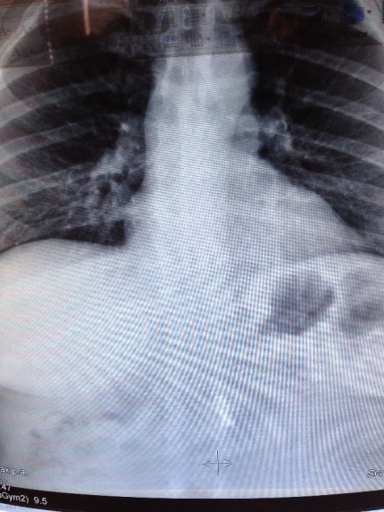 Figure 3: Erect abdominal radiograph revealed a metallic radio-opaque linear foreign body, shaped like a XXX, projecting in the middle part of the abdomen.