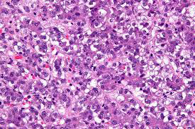 Figure 2: Hepatoblastoma exemplifying trabeculae and cell nests of immature hepatoblasts imbued with granular cytoplasm, intracytoplasmic glycogen, miniature nuclei and indistinct nucleoli [6].