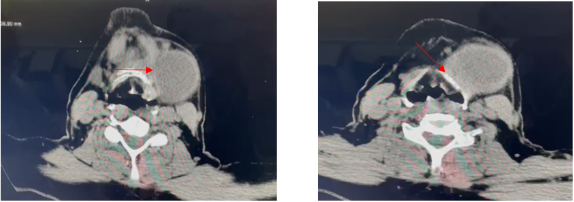 Figure 2: Axial Cuts of Contrast Enhanced Computed Tomogram. Figure 2A: Arrowhead Showing the Lesion Abutting Hyoid. Figure 2B: Arrowhead Showing the Lesion to Be Adherent to Thyroid Cartilage.