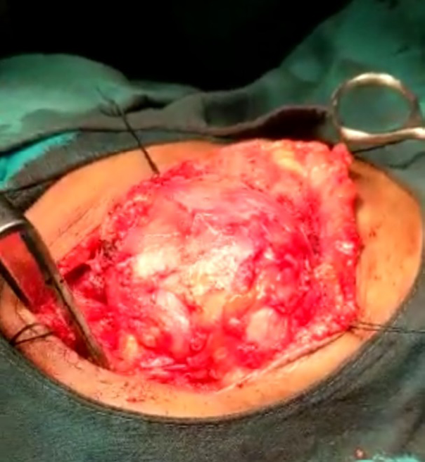 Figure 3: Yellowish Brown Mass which was Firmly Adherent to Surrounding Tissues.