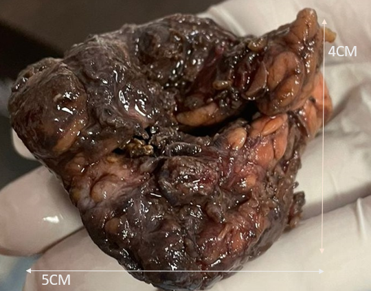 Figure 4: Post-Op Specimen Ventral Surface.