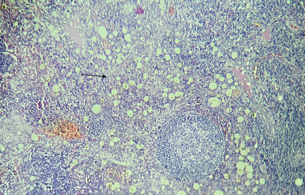 Figure 8: Hyperplastic Follicles & Oil Droplets in Peri- Follicular Areas.