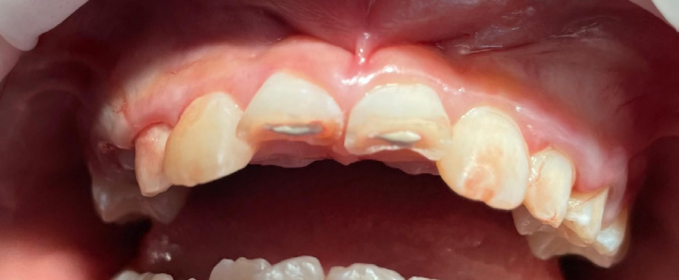 Figure 4: Straight post op view of the crown fragments reattachment.