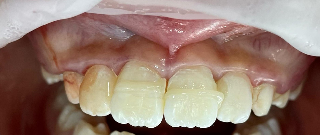 Figure 8: Buccal swelling associated with UR1.