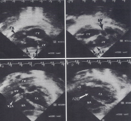 Figure 3: Two-dimensional echocardiographic video frames demonstrating a. an atretic tricuspid valve (ATV) between the right atrium (RA) and right ventricle (RV), b. a large sub-truncal ventricular septal defect (VSD), c. thickened and somewhat domed truncal valve (TV) leaflets, and d. the origin of the pulmonary artery (PA) from the posterior aspect of the _truncus_ _arteriosus_ (TA). LA, left atrium; LV, left ventricle. Reproduced from Rao PS, et al. [14].
