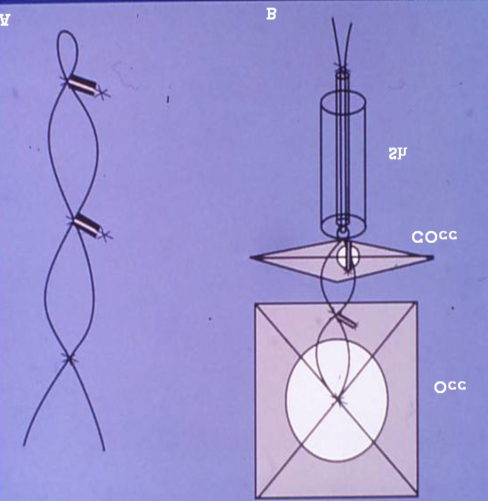 Figure 7: Selected frames from aortic arch (Ao) cine-angiograms in the lateral views, prior to (A) and 10 minutes after (B) transcatheter closure of a patent ductus arteriosus (PDA) with the buttoned device. The PDA (arrow) is clearly seen in A. An aortogram following occlusion (B) but before disconnecting the loading wire (LW) revealed no opacification of the ductus; ductal diverticulum (DD) is seen. DAo, Descending aorta; S, sheath used to deliver the device. Reproduced from Rao PS, et al. [19].