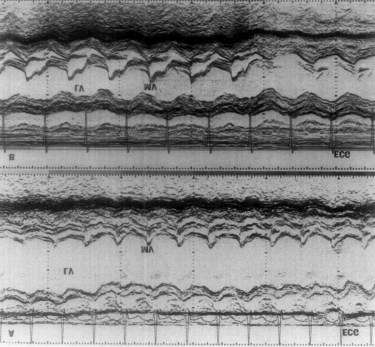 Figure 9: A. A chest x-ray in postero-anterior view at presentation, showing marked cardiomegaly and pulmonary venous congestion. B. A dramatic improvement of the cardiac size and pulmonary venous congestion on a chest x-ray obtained 12 months following balloon angioplasty. Reproduced from Saluhuddin, et al. [24].