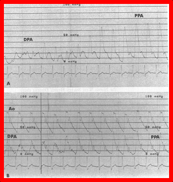Figure 10: Selected cine frames in lateral view of pulmonary artery angiogram demonstrating narrowing (arrow in A) of the pulmonary artery that developed following Jatene operation. Frame B illustrates (arrow in B) improvement in the obstruction. The pressure gradient improvement is shown in Figure 11. Reproduced from Rao [17].