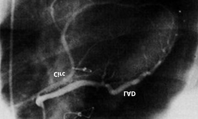 Figure 13: Coronary angiogram of the left main coronary artery demonstrating a normal left anterior descending artery (LAD) with an absence of the circumflex coronary artery. The distal circumflex is seen filling in a retrograde fashion from the LAD. Reproduced from Chopra et al. [28].