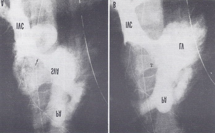 Figure 3: Selected cine frame of an inferior vena caval (IVC) angiogram in postero-anterior projection demonstrating the narrowing (arrow) of the inferior limb of the Mustard baffle (A). This narrowing improved significantly following balloon angioplasty (B). PA, pulmonary artery; SVA, systemic venous atrium. Reproduced from Rao PS, et al. [7].