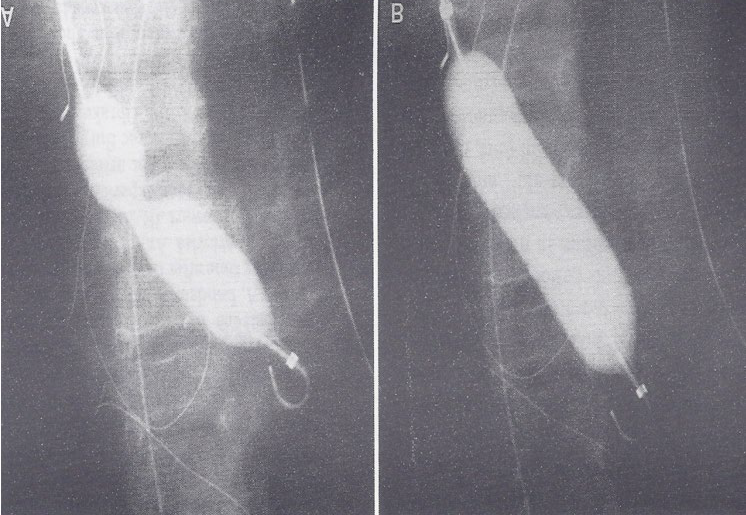Figure 5: Selected cineradiographic frames of a balloon angioplasty catheter positioned across the narrowed inferior limb of the Mustard baffle, demonstrating waisting of the balloon (A) during the initial phases of balloon inflation, which was completely abolished (B) on further inflation of the balloon. No residual waisting was noted during the second and third balloon inflations (not shown). Reproduced from Rao PS, et al. [7].