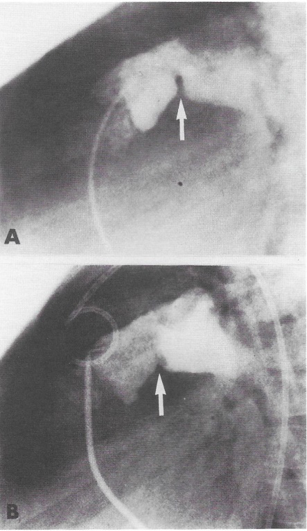 Figure 9: Selected video frames of a two-dimensional echocardiogram of the inferior limb of the Mustard baffle (a) in a 15-year- old child, showing the obstructed area (arrow). Color flow mapping (b) shows that flow acceleration and the turbulence starts at this point, confirming the hemodynamic significance of the two-dimensionally visualized narrowing. Also, note the dilated inferior vena cava (IVC). The second row of video frames (c and d) are from the same patient, and were obtained six months after balloon dilatation. Note the wider opening on the two-dimensional echocardiographic frame (c) and the lack of flow acceleration and turbulence (d). Reproduced from Rao, et al. [8].