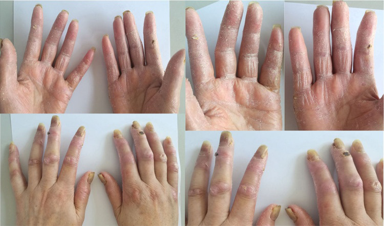 Figure 1: Severe Hand-Foot Syndrome in the Patient After the Fourth Cycle of Chemotherapy, with Loss of Fingerprints, Peeling of Skin, Blisters, Chapping and Scabbing in Some Area.