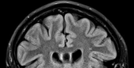Figure 1: An MRI Scan Sagittal Section with a Closer Look to the Cavum Septum Pellucidum which Raine Claim that is a Sign of Pychopaths!