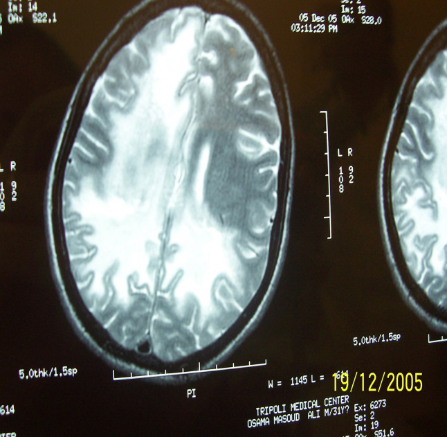 Figure 1: The MRI of the brain in case 1 showing hyper dense area involving the white matter of both cerebral hemispheres more pronounced on the right side.