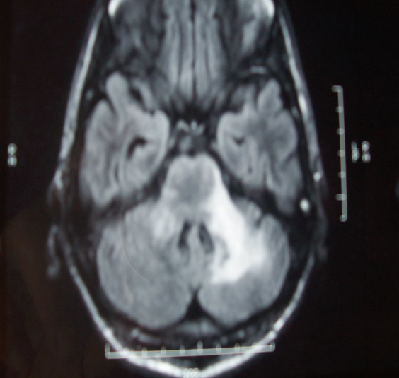 Figure 3: The MRI scan appearance of the brain in a case of PML showing hyperdense area involving the white matter of the left cerebellar hemisphere, the peduncle of the right cerebellar hemisphere and parts of the midbrain.