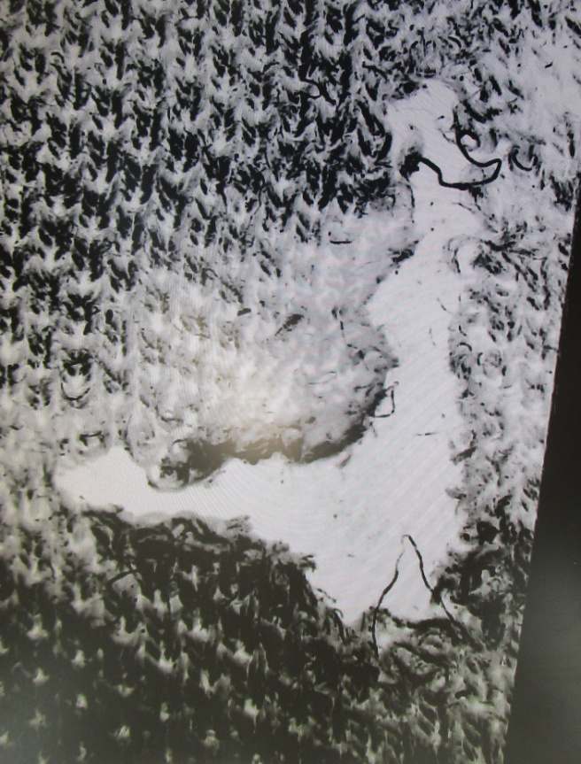 Figure 14: Suspected Stabbing/Cut Mark (Ex-B) (Under Microscope).