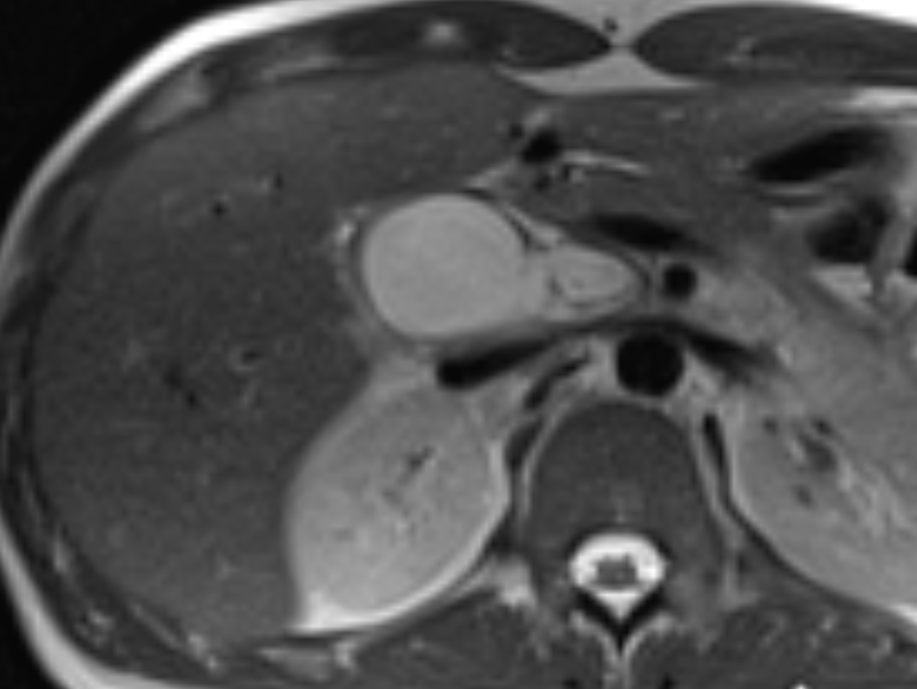 Figure 1: showing the major mass, coronal contrast enhanced T1WIMR.